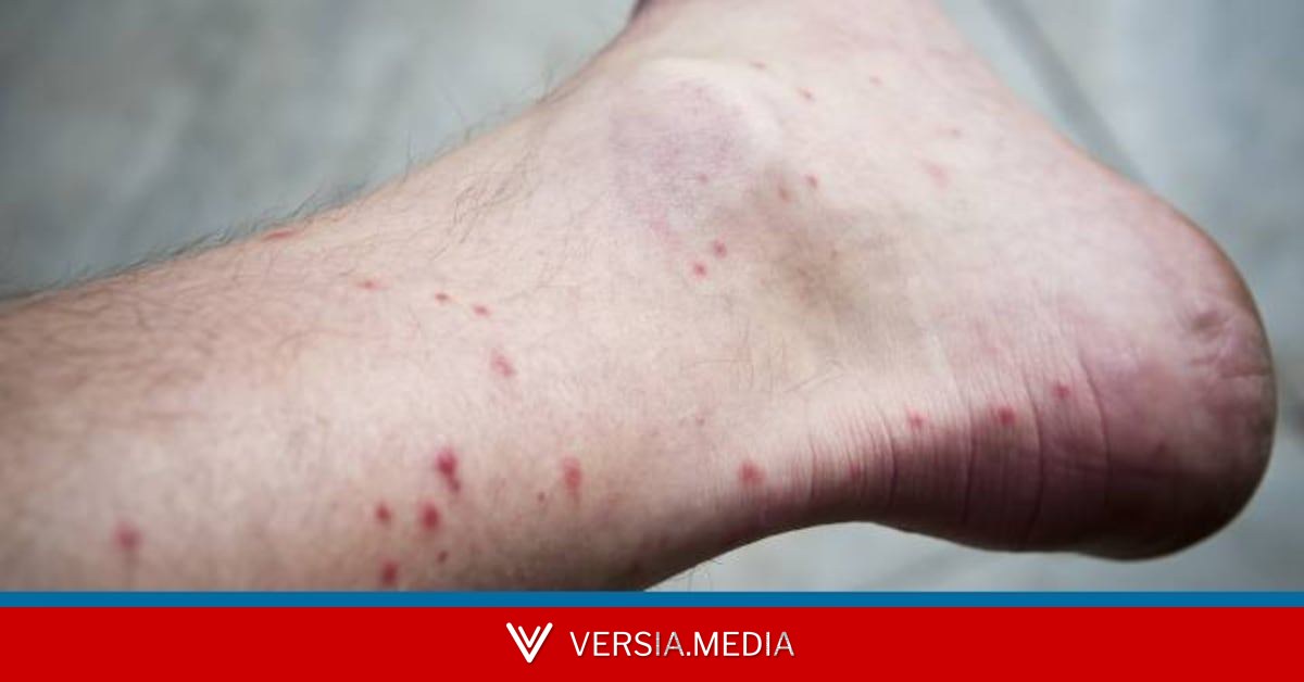 ¿Por qué los mosquitos se ceban con nuestros tobillos? — World News | Versia.media